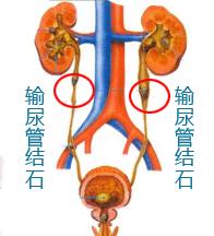出现这六种情况警惕尿毒症,关于尿毒症下列哪种说法不正确