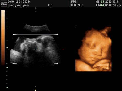 胎盘老化对胎儿有什么影响,胎盘老化对胎儿的影响