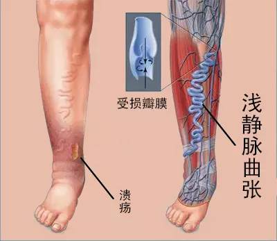 腿上的青筋弯曲是静脉曲张吗,腿上好多青筋是静脉曲张前兆吗
