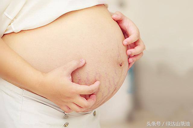 有效祛妊娠纹的产品推荐,除妊娠纹的国产神器