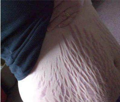 没长妊娠纹的妈妈是这样做的,二胎孕期不长妊娠纹的小妙招