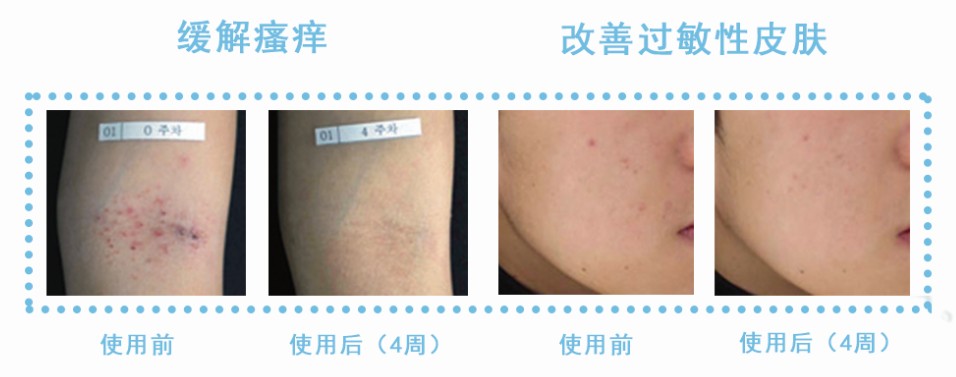 如何快速去除黑头,如何快速去除黑头和痘痘