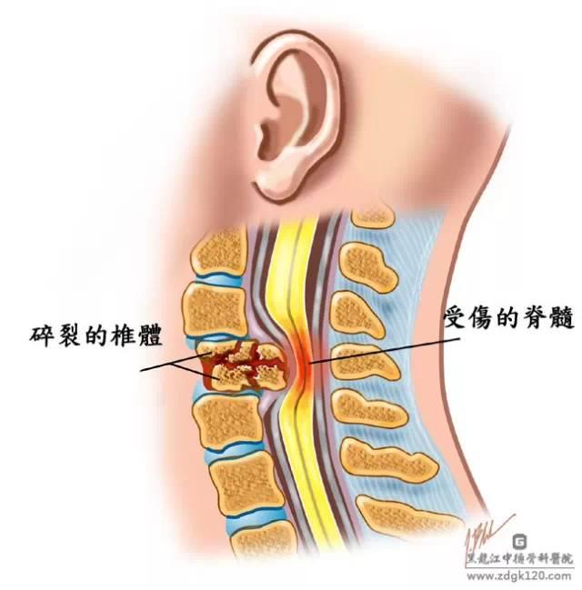 中医将颈椎病分类,神经根型颈椎病分类