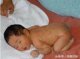 宝妈去痱子的方法,宝妈去痱子的秘方