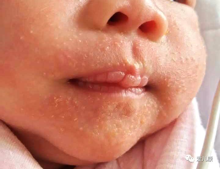 维生素ad一天一粒会中毒么,小孩一次性吃了20维生素ad