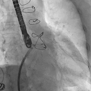 「病例」80岁房颤患者抗凝治疗后反复咯血，咋办？