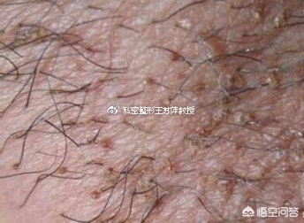 夏季多发皮肤病有哪些？什么是阴毛囊炎？