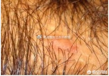 夏季多发皮肤病有哪些？什么是阴毛囊炎？