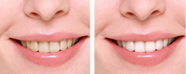 如何洁白牙齿的小妙招,牙齿黄怎么办快速解决方法