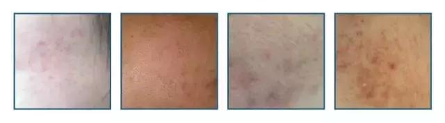 治疗痘印痘坑毛孔粗大的药,男士毛孔粗大痘坑痘印修复