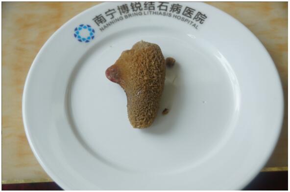 罕见!博锐医院取出像“7”又像“1”的巨大结石