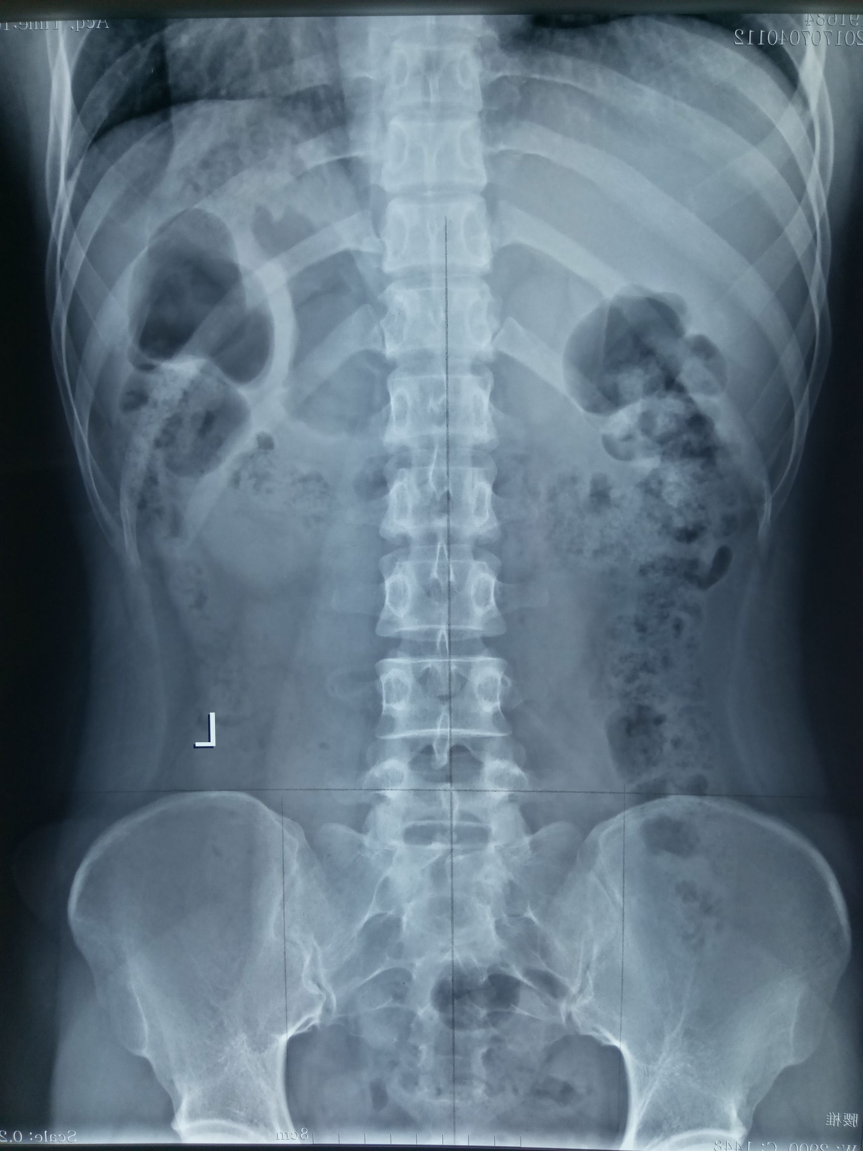 脊椎变形可以自行矫正,脊椎变形矫正视频