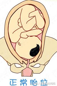 胎位不正的原因和预防方法,第一胎胎位不正第二胎也胎位不正