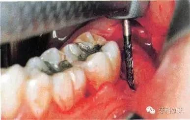 口腔拔牙图片,口腔拔牙麻醉多久消退