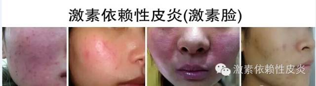 激素脸什么症状,什么是激素脸激素脸的症状是什么