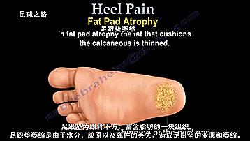 足跟痛最常见病因,足跟痛警惕四种疾病