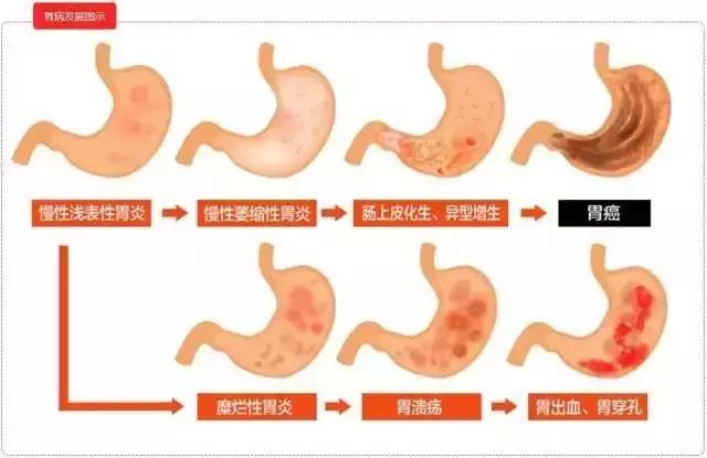 日本胃癌治愈率为什么高达80%,日本胃癌治愈率最高的药