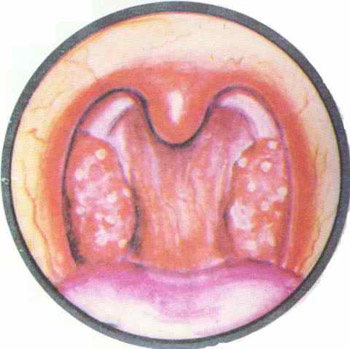 鸡呼吸道疾病用药,急性上呼吸道感染细菌感染用药