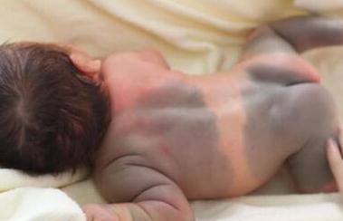 胎记表面粗糙像结痂,胎记表面有小疙瘩