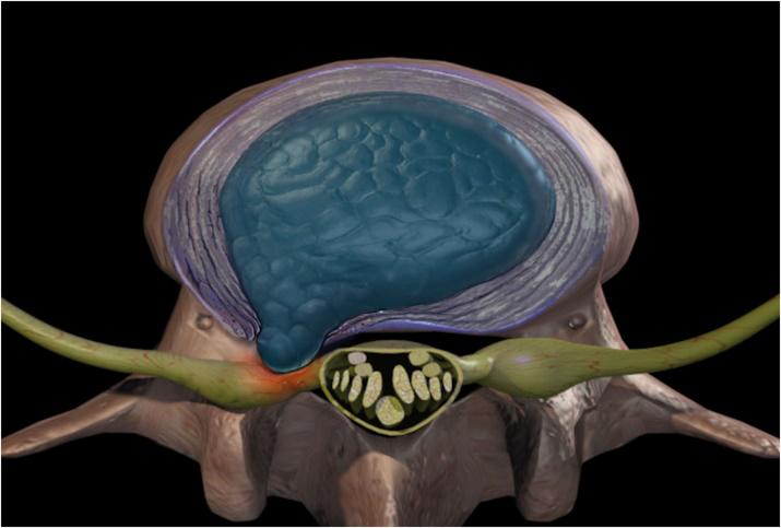 腰椎间盘突出能够完全治好吗,腰椎间盘突出能够手术吗