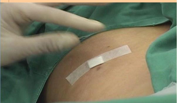 腰椎间盘突出能够完全治好吗,腰椎间盘突出能够手术吗