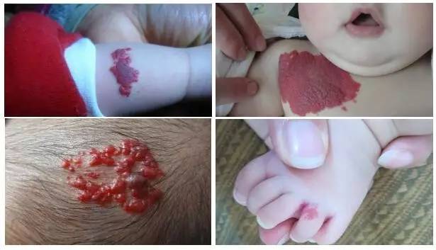 婴幼儿脸上有胎记怎么办,治疗婴幼儿红胎记哪里好