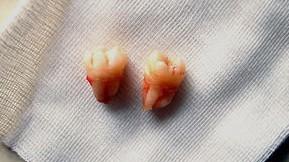 拔了智齿从旁边大牙流血,拔了智齿有个洞没流血