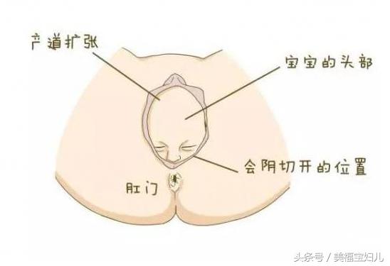 我为自己辟谣!告诉你会阴到底该不该切