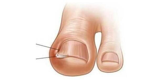 脚趾甲长到肉里很疼怎么止疼,脚趾甲长肉里一碰就痛咋办