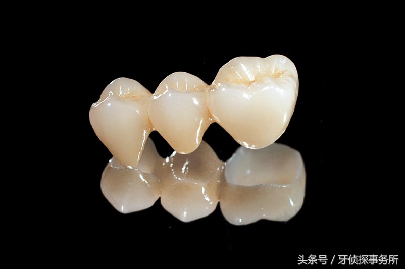 烤瓷牙和全瓷牙的区别和寿命,一颗全瓷牙冠两千贵吗