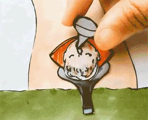 剖宫产是横切好还是竖切？剖宫产后要注意什么？