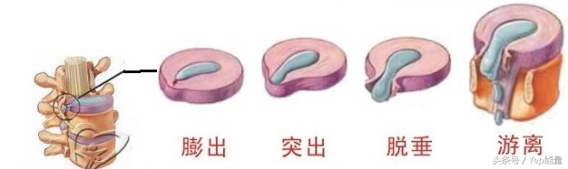患者必须要了解的腰椎间盘突出的自我治疗与康复锻炼