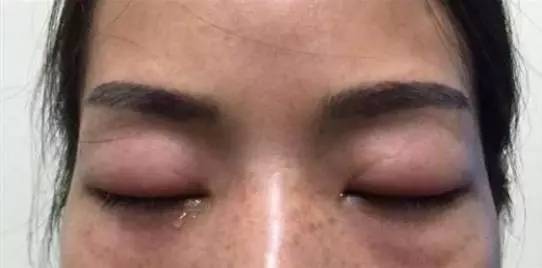 做了美瞳线眼睛红肿流眼泪,做完美瞳线眼红肿痛
