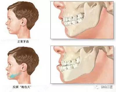 「医生说」“地包天”不容忽视口腔正畸专家提醒，越早接受治疗效果越好