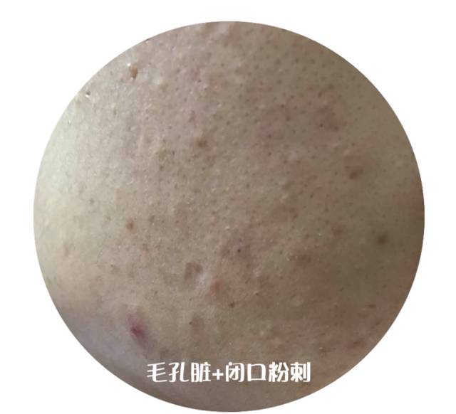 战痘合集完整版,战痘大结局完整版