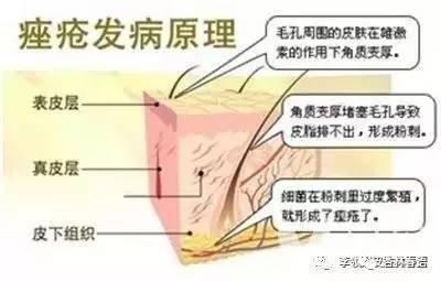 疮疖和青春痘有区别吗,痤疮是脓包吗