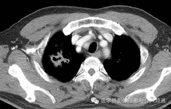 咳嗽排除了肺部的问题,咳嗽为什么比不咳好