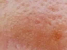 十年战痘血泪史详解,战痘知识分享