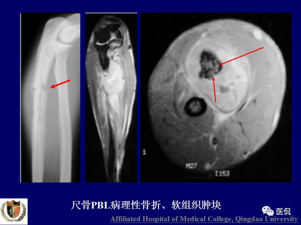 徐文坚老师精讲：原发性骨淋巴瘤影像学诊断医学影像精品PPT