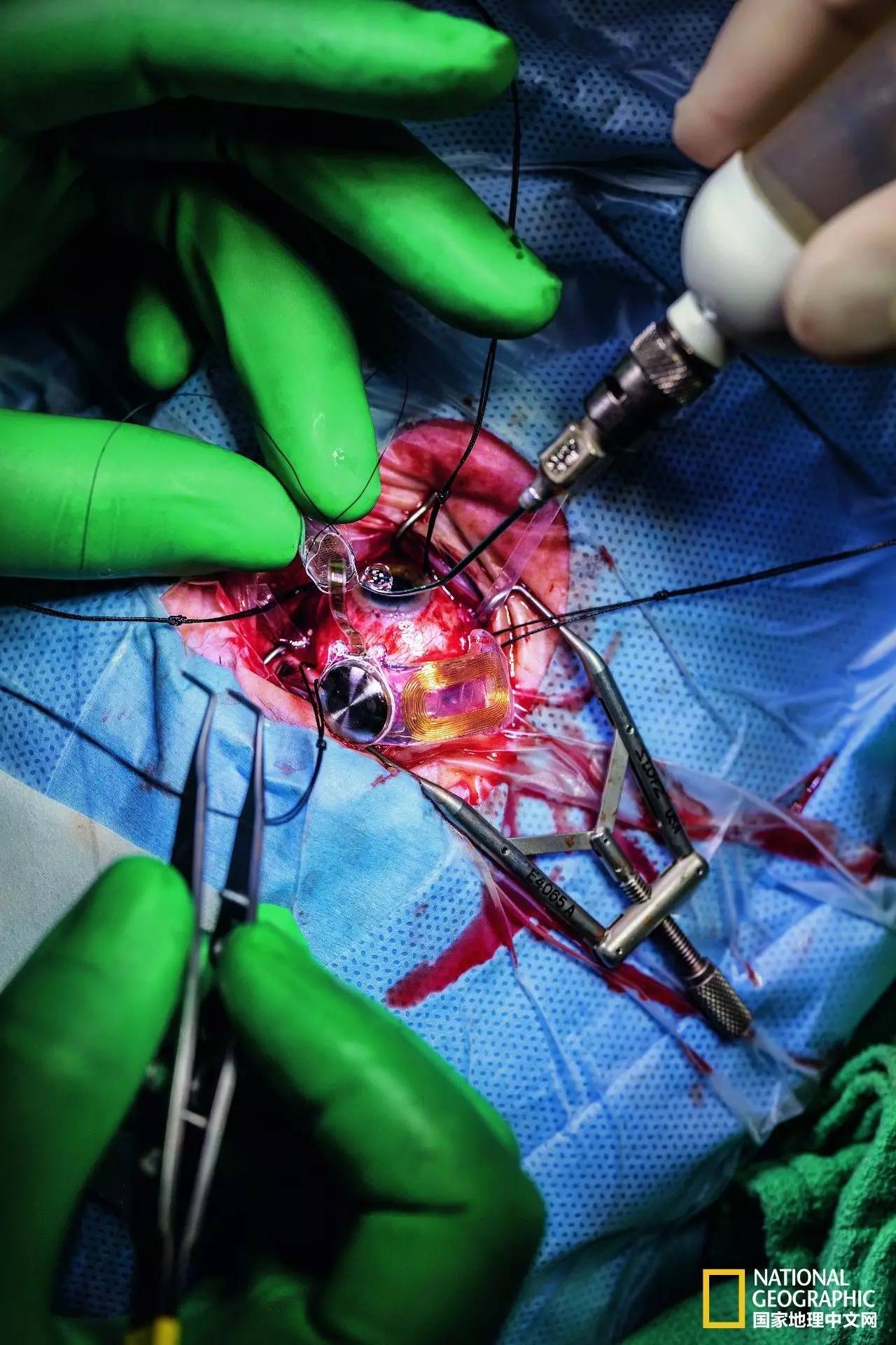 这完全不是科幻片！仿生义眼、干细胞移植、基因疗法……盲症也许马上就要被终结了！