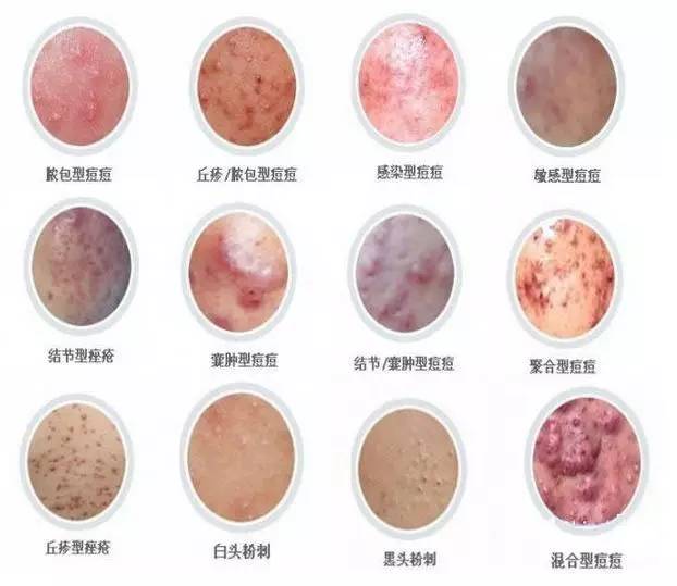 再也不担心脸上长痘痘,再也不用因为痘痘而烦恼