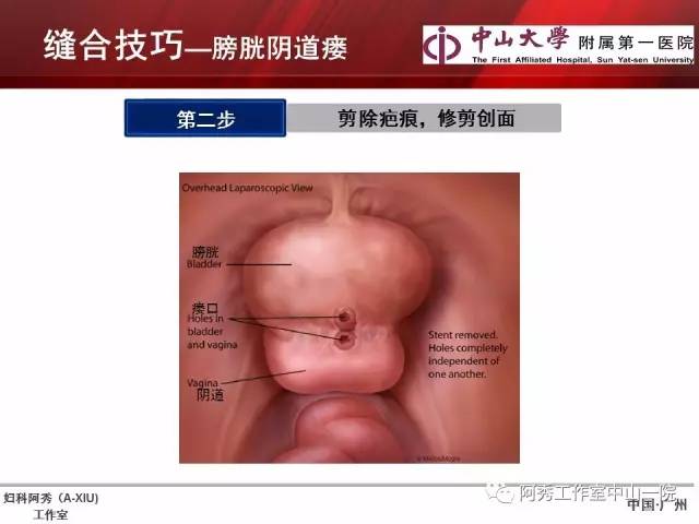 妇科腹腔镜下常用缝合技巧
