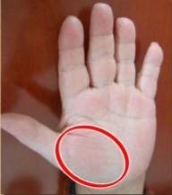 手上发红发紫是怎么回事,手部发青要警惕