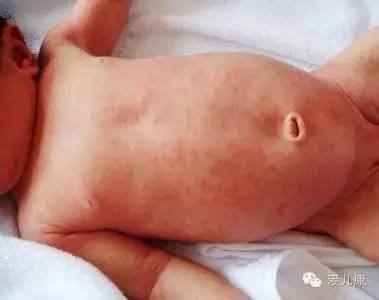 幼儿急疹被医生诊断为病毒感冒,幼儿急疹出疹期宝宝为什么会烦躁