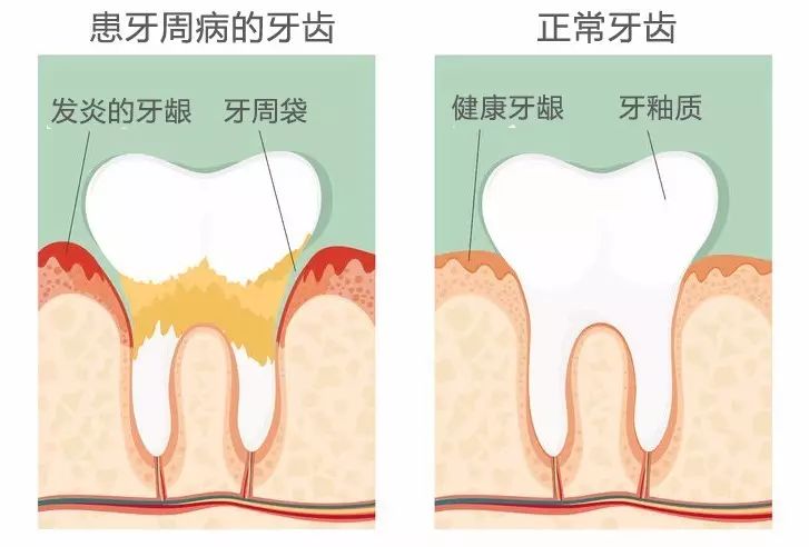 早上刷牙老是牙龈出血是什么原因,牙龈肿痛刷牙出血怎么回事