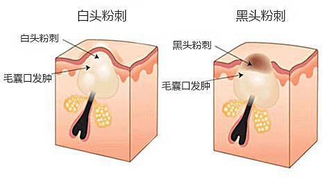 黑头反反复复去不掉,黑头老是反复怎么去解决