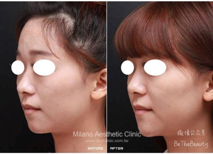 鼻翼宽鼻头大怎么办,塌鼻子鼻翼宽妆容