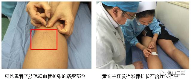 血管迂曲能好转吗,血管弯曲能治好吗