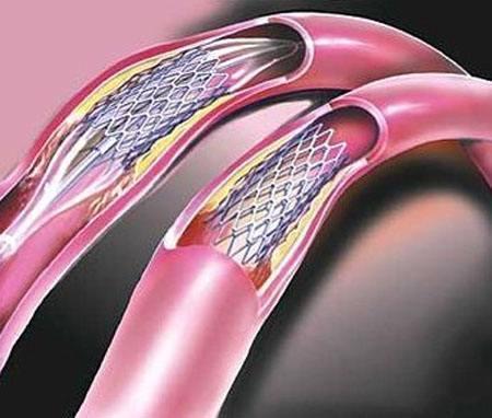 心脏支架可以做头部磁共振吗,心脏钛合金支架能做磁共振吗