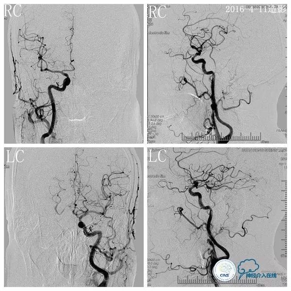 天坛医院脑血管狭窄手术做得好吗,天坛医院动脉狭窄介入手术费用